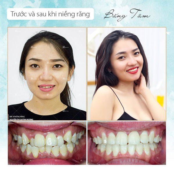 Trước và sau khi niềng răng quá khác biệt, thật khó tin đó là cùng một người - 3