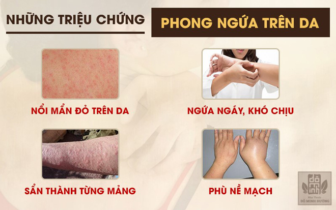 Bệnh phong ngứa là gì? Nguyên nhân, triệu chứng và cách chữa hiệu quả - 2