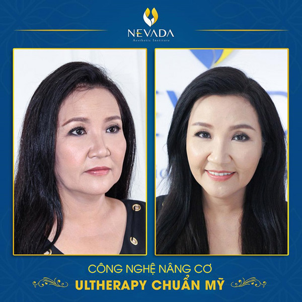 Diễn viên Ngân Quỳnh thay đổi hoàn toàn sau khi trẻ hóa làn da