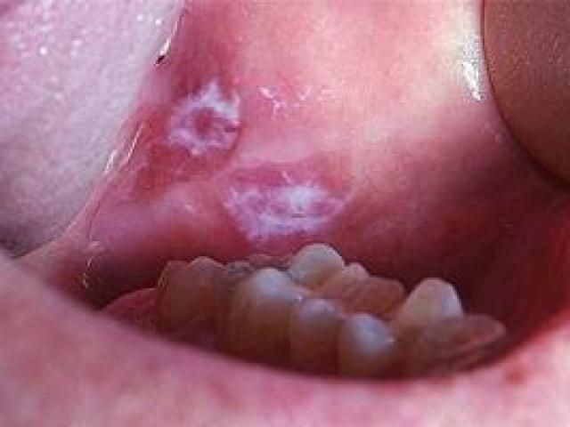 Sức khỏe đời sống - Vệt trắng lạ cảnh báo ung thư: Chuyên gia chỉ ra các dấu hiệu sau cần đi khám ngay