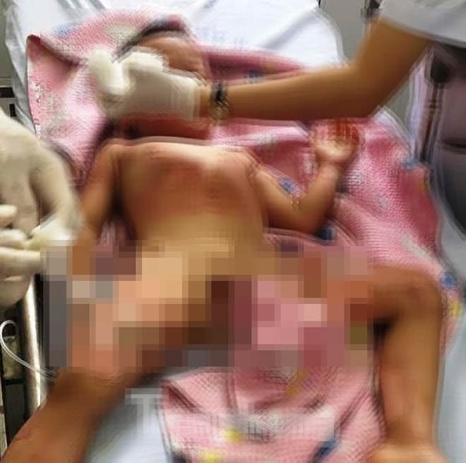 Một cháu bé bị bỏng nặng trong lúc học kỹ năng thoát hiểm tại trường. Ảnh: Tiền Phong&nbsp;&nbsp;