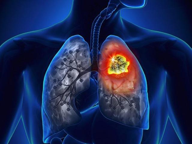 Sức khỏe đời sống - Đau xót "thủ phạm gây ung thư" từ 4 người đàn ông trong nhà khiến người phụ nữ mắc bệnh