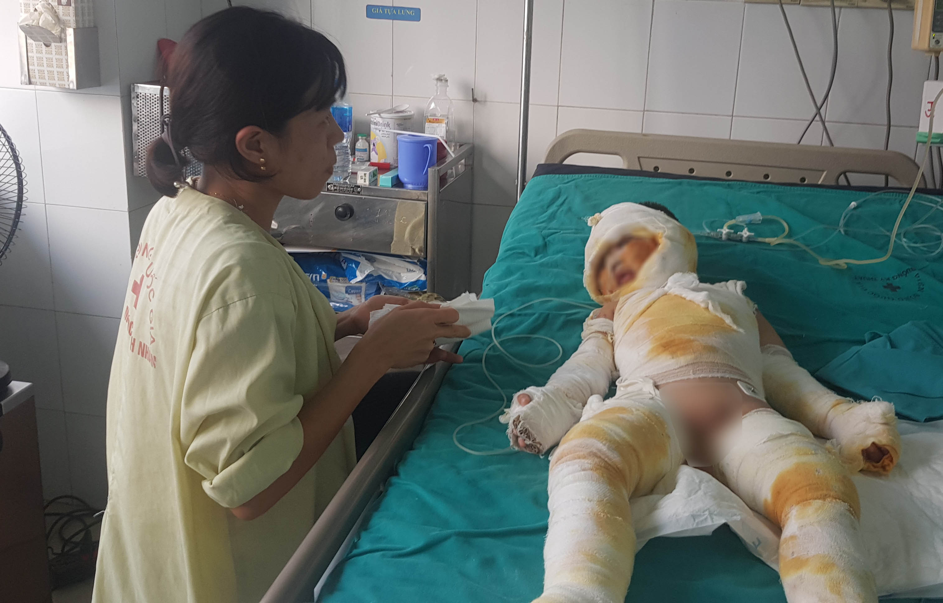 Bệnh nhi bị bỏng nặng đang điều trị tại BV Bỏng Quốc gia