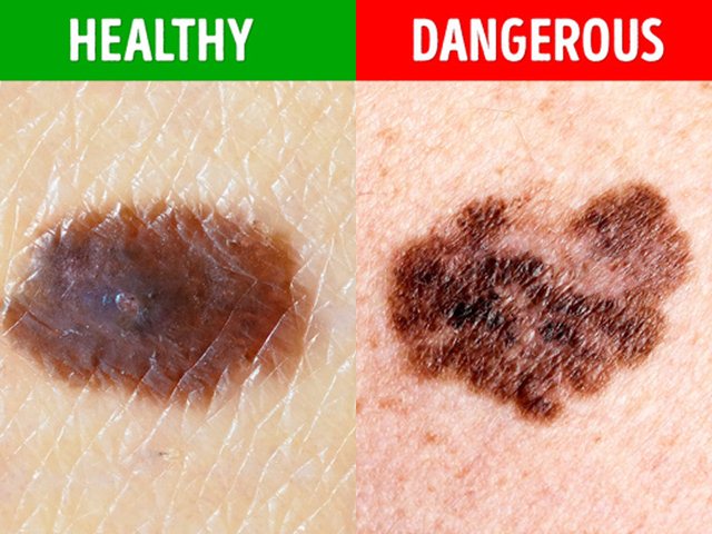 Sức khỏe đời sống - Nốt ruồi trên người có 5 đặc điểm này chứng tỏ bạn đang mắc bệnh nguy hiểm