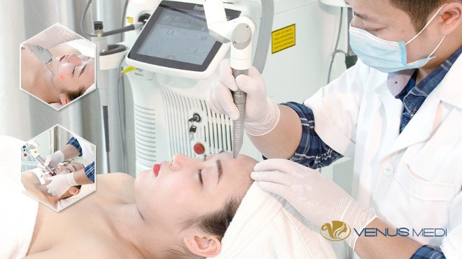 Fotona 4D là một trong những công nghệ nổi bật được tích hợp trong phương pháp Multi Layer