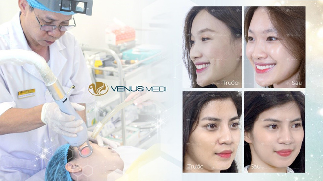 Multi Layer là phương pháp trẻ hóa da đa công nghệ với nhiều ưu điểm vượt trội