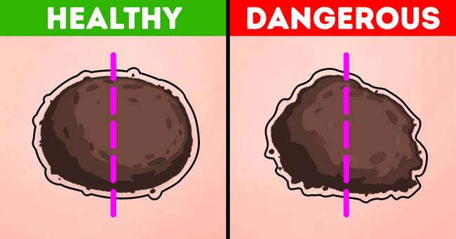 Nốt ruồi trên người có 5 đặc điểm này chứng tỏ bạn đang mắc bệnh nguy hiểm - 1