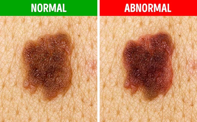 Nốt ruồi trên người có 5 đặc điểm này chứng tỏ bạn đang mắc bệnh nguy hiểm - 3