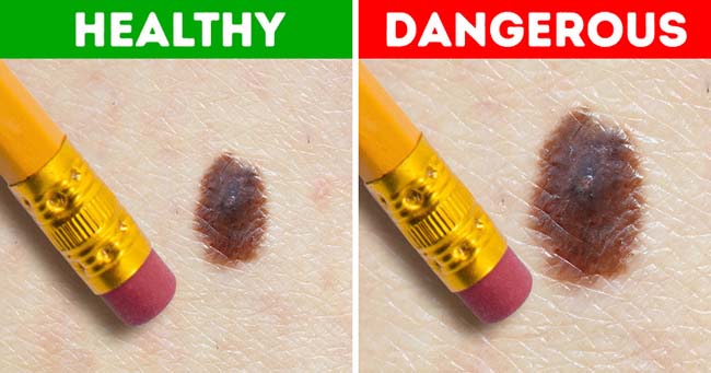 Nốt ruồi trên người có 5 đặc điểm này chứng tỏ bạn đang mắc bệnh nguy hiểm - 4