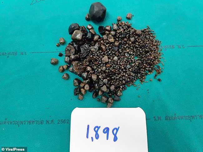 Bác sĩ gắp ra gần 2.000 viên sỏi mật trong bụng cụ bà 60 tuổi bị táo bón - 1