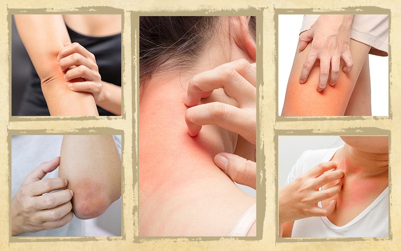 Ngứa toàn thân do nổi mề đay: Nguyên nhân và cách điều trị hiệu quả - 1