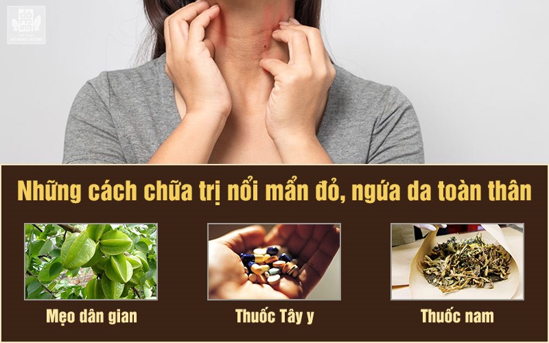 Ngứa toàn thân do nổi mề đay: Nguyên nhân và cách điều trị hiệu quả - 3