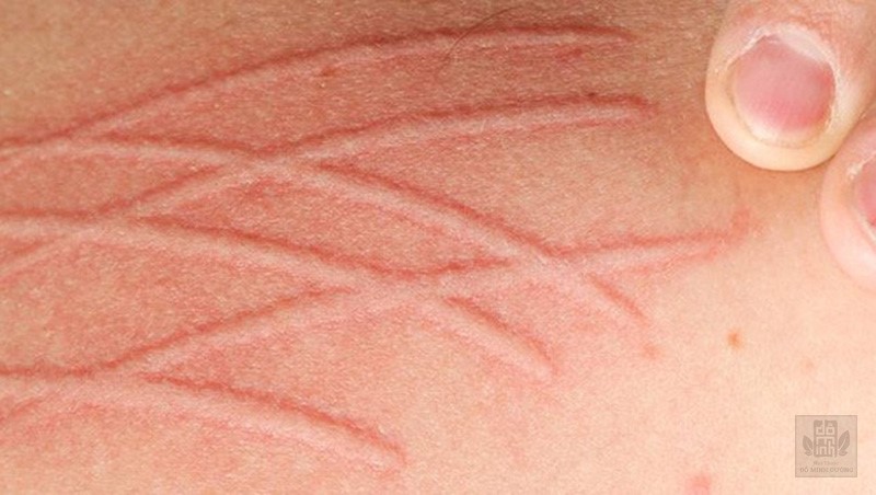 Da vẽ nổi là bệnh gì? Biểu hiện dị ứng da vẽ nổi và cách điều trị hiệu quả - 1