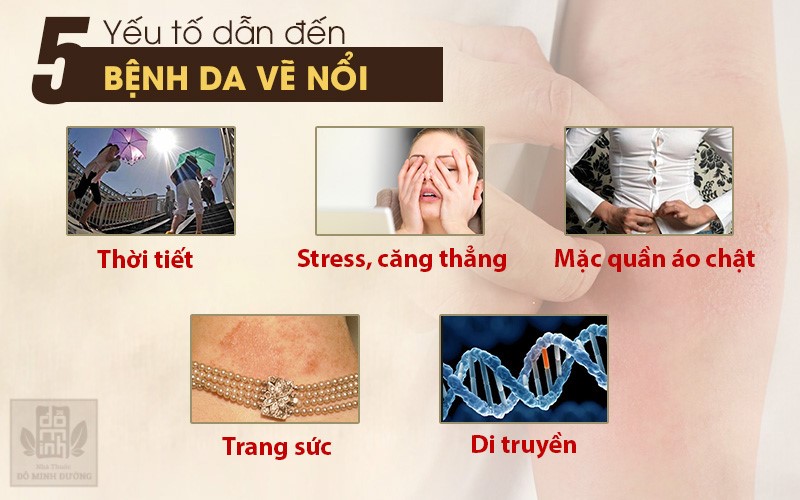 Da vẽ nổi là bệnh gì? Biểu hiện dị ứng da vẽ nổi và cách điều trị hiệu quả - 2