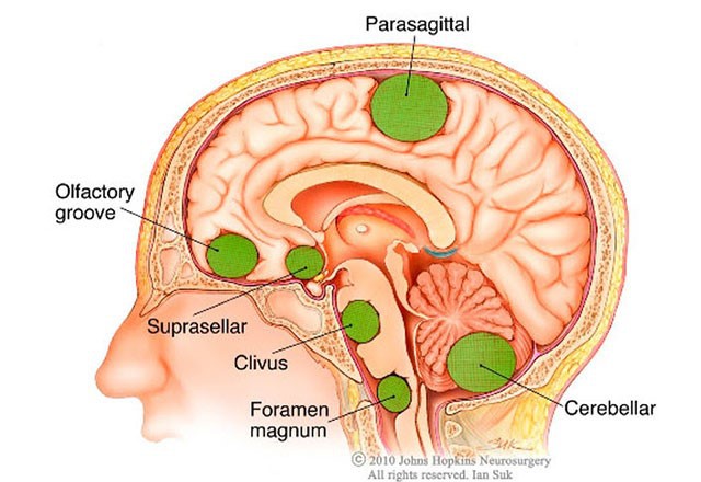Các khối u não có thể nằm ở bất kỳ vị trí nào trong hộp sọ