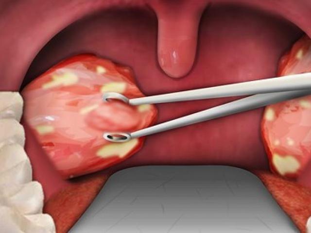 Sức khỏe đời sống - Tử vong do cắt amidan, trường hợp nào tuyệt đối không được cắt?