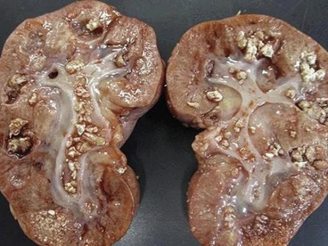 Sức khỏe đời sống - Thận đầy sỏi, nguy cơ ung thư "gõ cửa" vì nhiều người tích cực ăn những món này