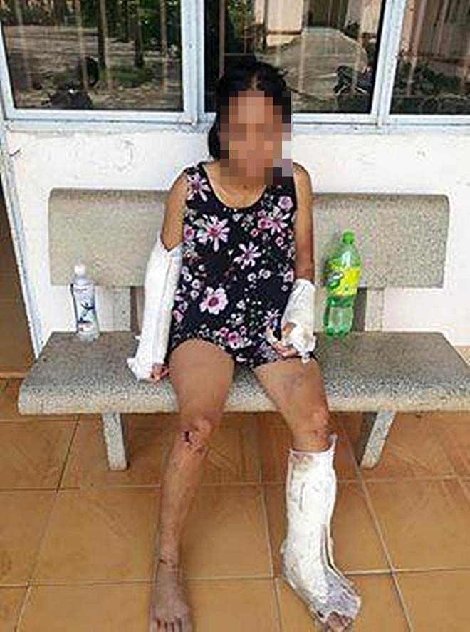 Nạn nhân bị chồng tấn công phải điều trị