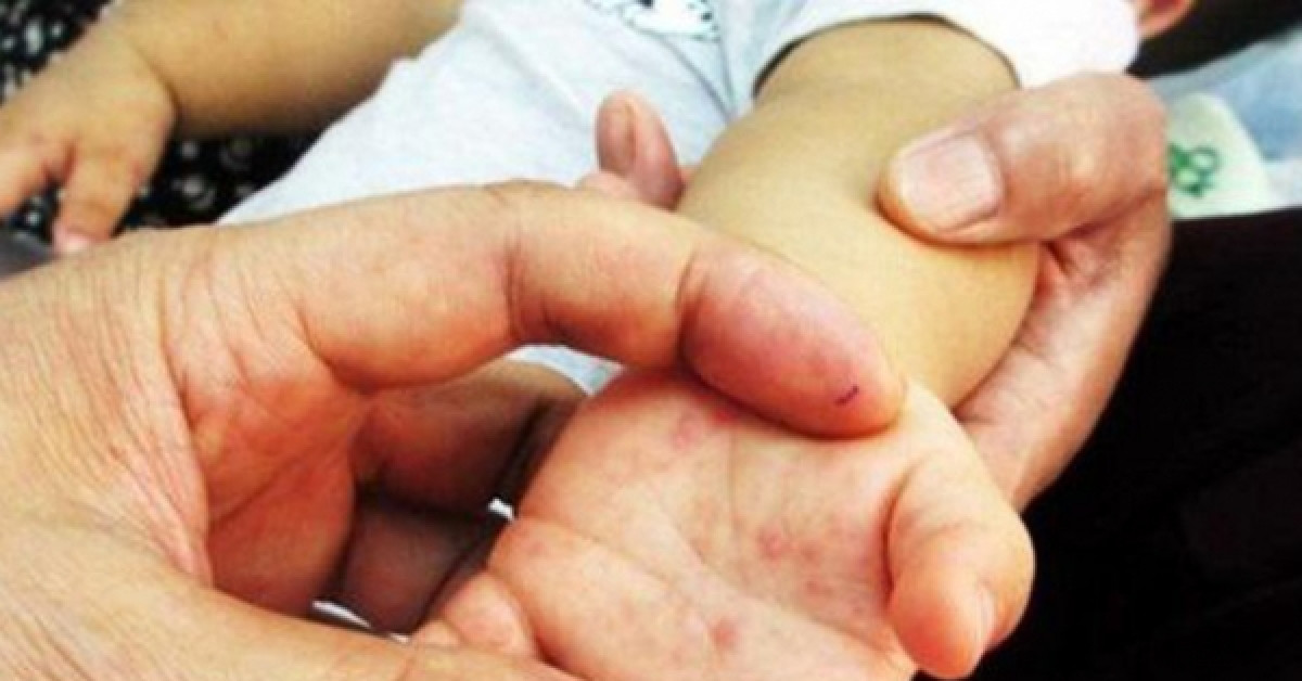Sức khỏe đời sống - Làm thế nào để xác định chính xác con bị mắc tay chân miệng?