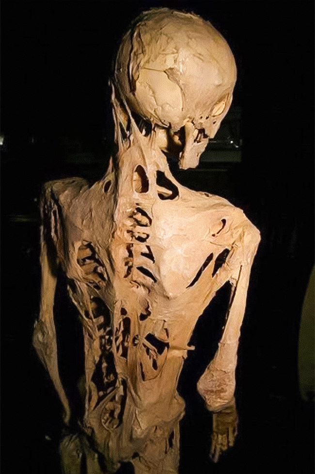 10 căn bệnh kỳ lạ cực hiếm gặp: không nguyên nhân, không thuốc chữa - 1