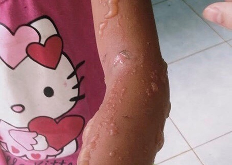 Các vết bỏng rát trên cánh tay bé B.H