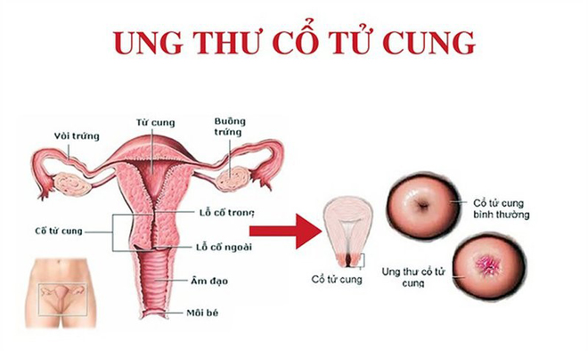 Biến chứng nguy hiểm của bệnh phụ khoa chị em văn phòng cần biết - 2