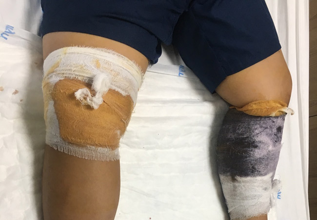 Vết thương sau khi được khâu và băng bó.