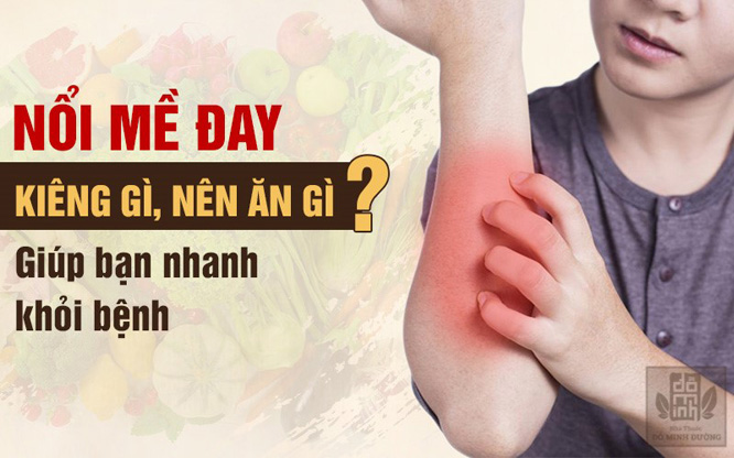 Bị nổi mề đay nên ăn gì? Kiêng gì? Chữa thế nào để hết mẩn ngứa? - 1