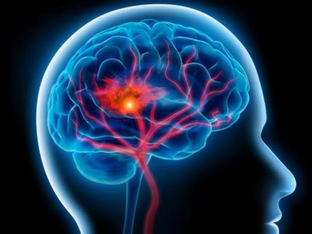 Phi thường - kỳ quặc - Tại sao nhiều người sau đột quỵ bỗng nói tiếng nước ngoài?