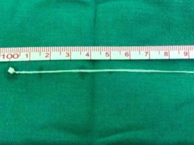 Phi thường - kỳ quặc - Đau đầu dữ dội, đi khám mới biết có con vật gớm ghiếc sống trong não 30 năm