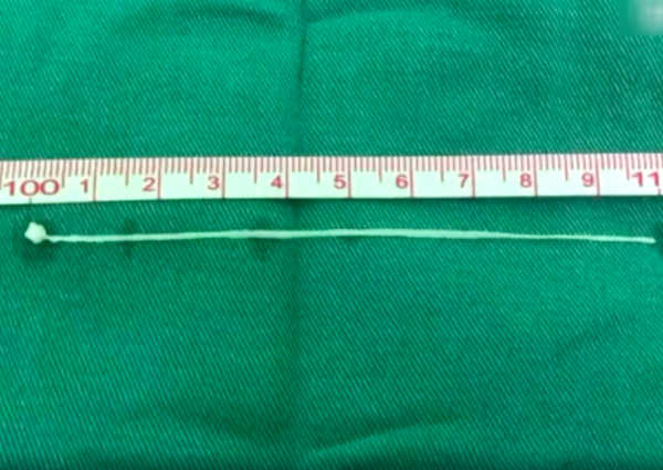 Con giun dài 10cm được gắp ra từ bên trong não bộ của bệnh nhân.
