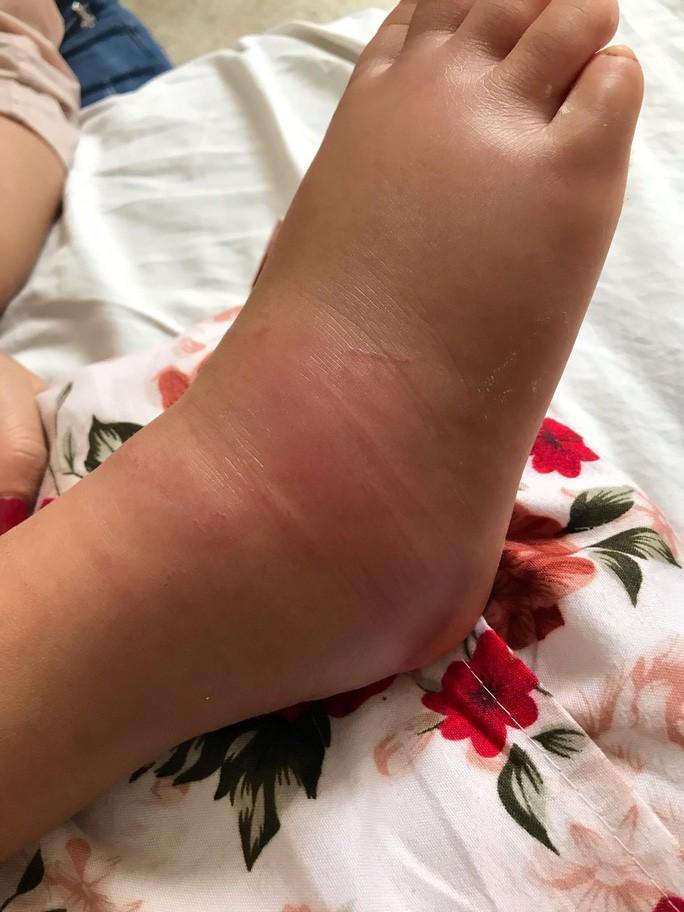 Chân của cháu bé sưng vù. Ảnh chị Thảo cung cấp