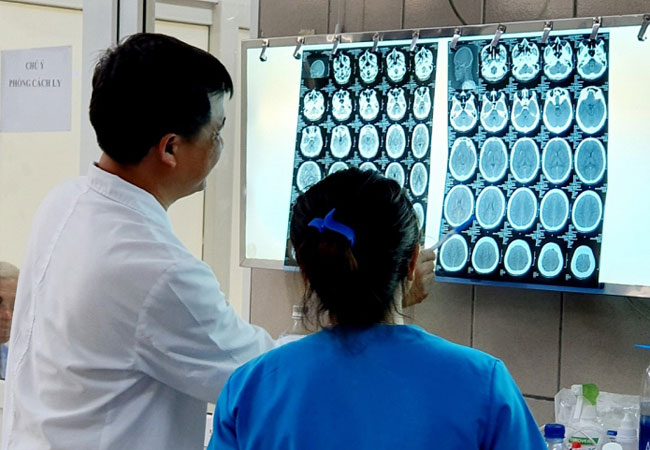 Hình ảnh phim chụp não bệnh nhân bị xuất huyết do ngộ độc ma túy đá