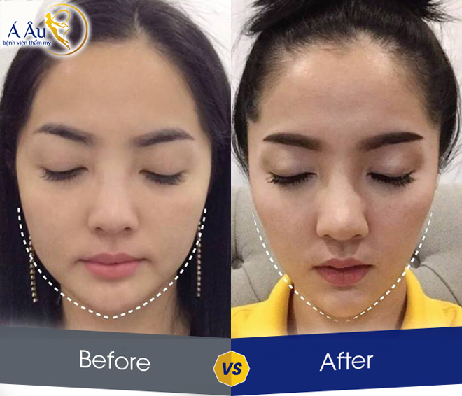 Kết quả tạo mặt V-line không phẫu thuật tại Bệnh viện thẩm mỹ Á Âu