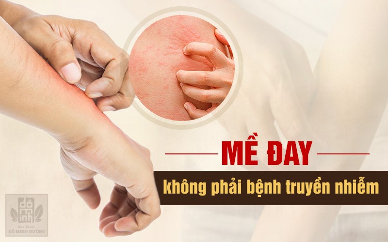 Nổi mề đay mẩn ngứa có lây không? Có tắm được không? Chữa trị thế nào? - 2