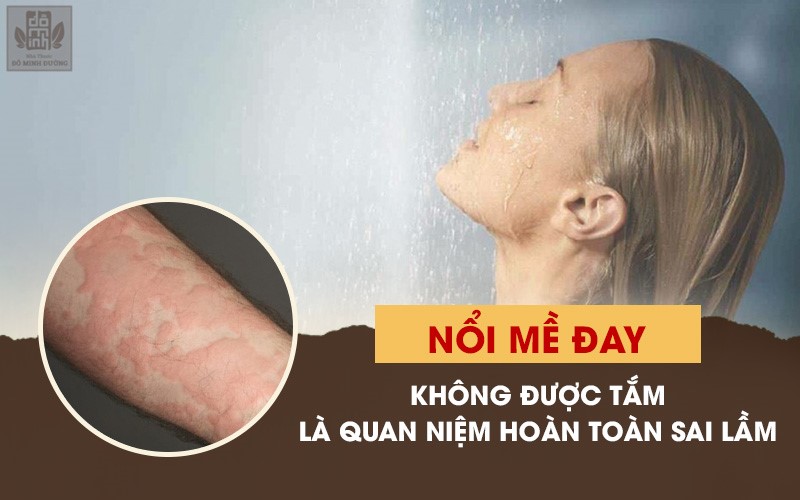 Nổi mề đay mẩn ngứa có lây không? Có tắm được không? Chữa trị thế nào? - 3