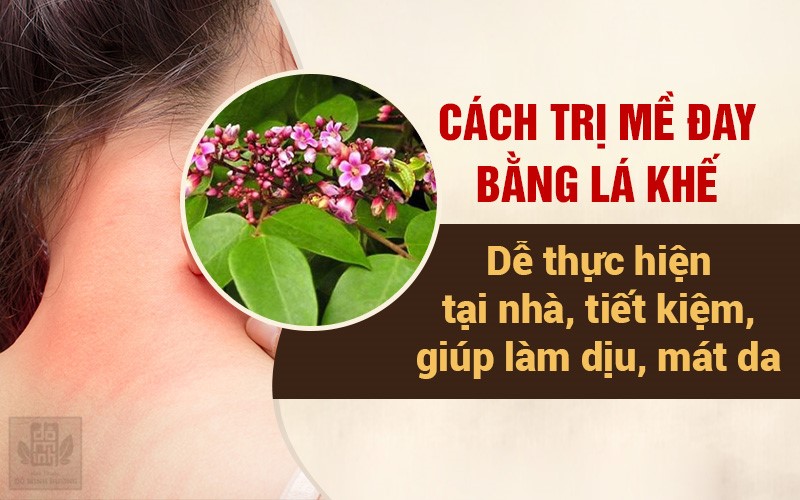 Nổi mề đay mẩn ngứa có lây không? Có tắm được không? Chữa trị thế nào? - 4