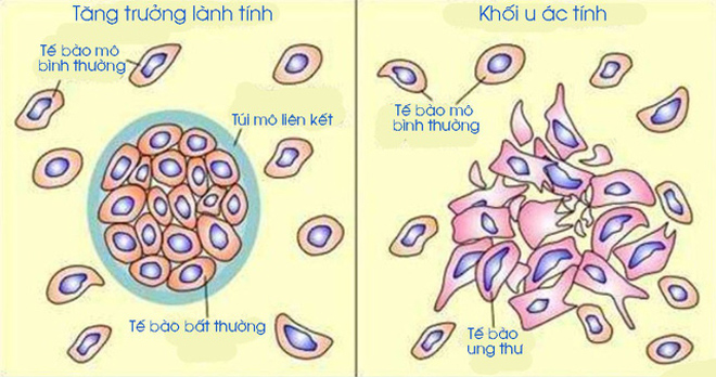 Khối u lành tính và khối u ác tính