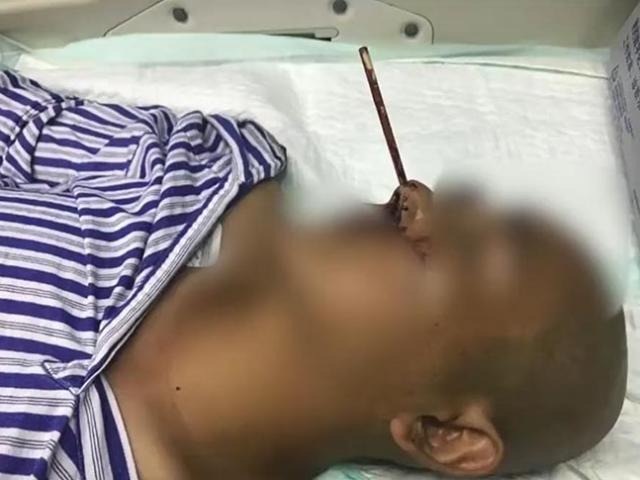 Sức khỏe đời sống - Ngoáy mũi bằng đũa, người đàn ông nhận cái kết đắng