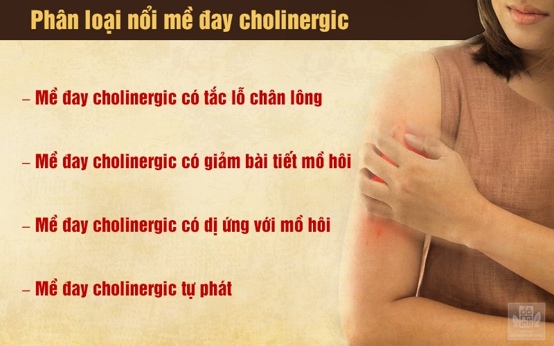 Mề đay cholinergic: Nguyên nhân, triệu chứng và các cách điều trị không kháng sinh - 2