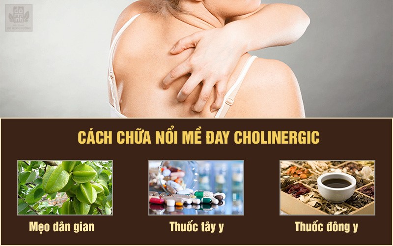 Mề đay cholinergic: Nguyên nhân, triệu chứng và các cách điều trị không kháng sinh - 3