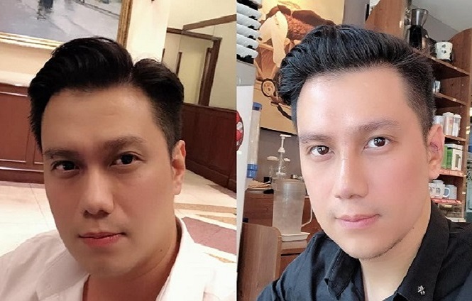 Việt Anh khiến nhiều người bàn tán vì phẫu thuật thẩm mỹ. 