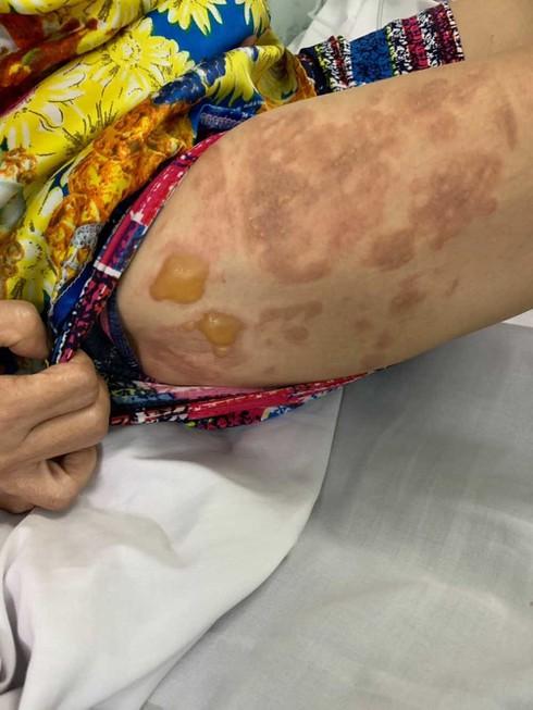 Bà Ly bị bỏng nặng sau khi bị bà Hạnh hất cả chảo dầu sôi vào người.