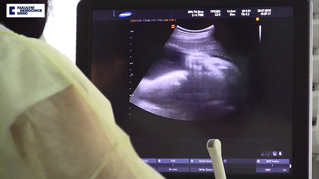 Mẹ bị chết não 117 ngày vẫn sinh ra em bé khỏe mạnh một cách thần kỳ - 2