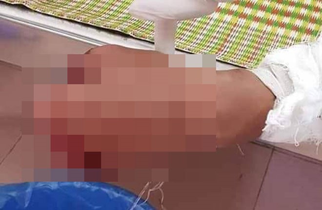  Bàn tay của anh Y bị nát do điện thoại phát do khi vừa sạc vừa dùng