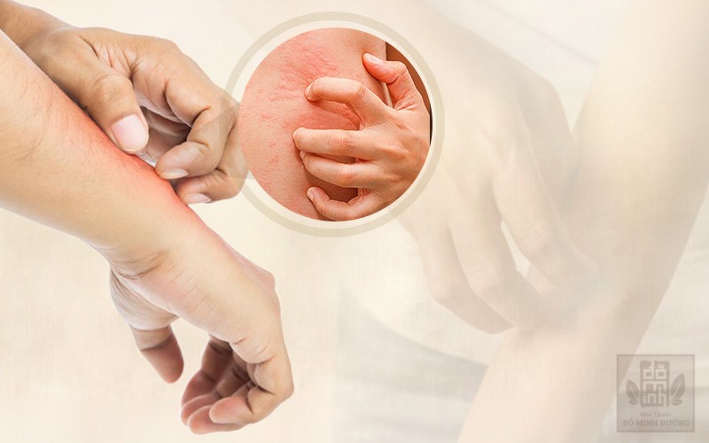 Nổi mề đay là gì? Nguyên nhân, triệu chứng và cách điều trị bệnh hiệu quả - 1