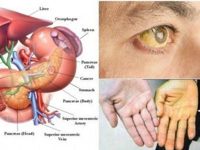 Sức khỏe đời sống - Mắc bệnh ung thư này chỉ 4% bệnh nhân có thể vượt qua: Những dấu hiệu cần nhớ!