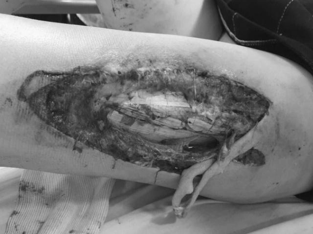 Sức khỏe đời sống - Từ vụ nữ CĐV bị trúng pháo sáng: Chuyên gia y tế cảnh báo tác hại cực kỳ nguy hiểm