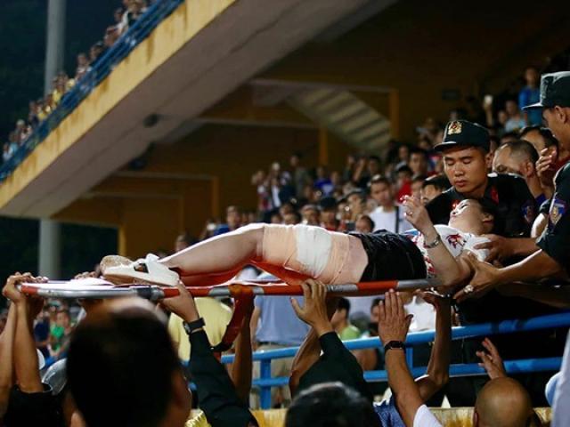 Tin tức trong ngày - Nóng trong tuần: Trúng pháo sáng trên SVĐ, nữ CĐV phải phẫu thuật 2 lần vì bỏng đến tận xương