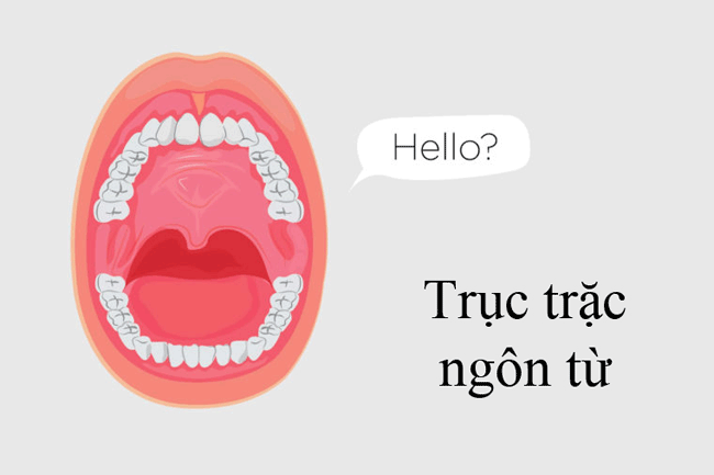10. Trục trặc ngôn từ: Ung thư miệng ảnh hưởng đến lưỡi có thể làm cho việc nói chuyện trở nên đau đớn hoặc có thể khiến việc di chuyển lưỡi của bạn trở nên khó khăn hơn. Khi một trong những điều đó xảy ra, bạn có thể nhận thấy mình gặp khó khăn khi phát âm những từ mà bạn chưa bao giờ gặp rắc rối trước đó.
